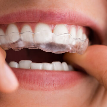 How Does Invisalign Work? The Clear Aligners Explained