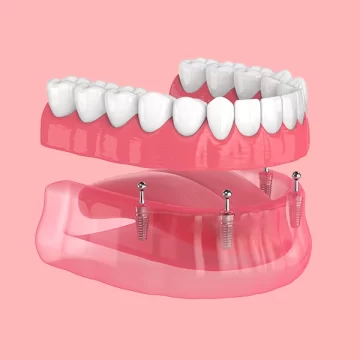 All-on-4 dental implants
